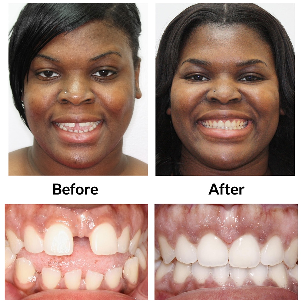 Invisalign Mississauga